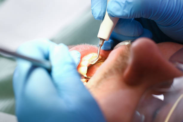 Best Emergency Treatment for Dental Infections or Abscesses in South Boston, VA