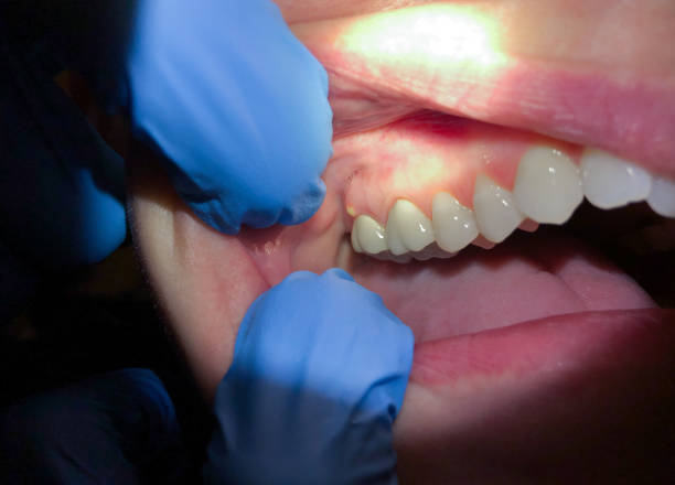 Best Emergency Dental Care for Broken or Chipped Teeth in South Boston, VA